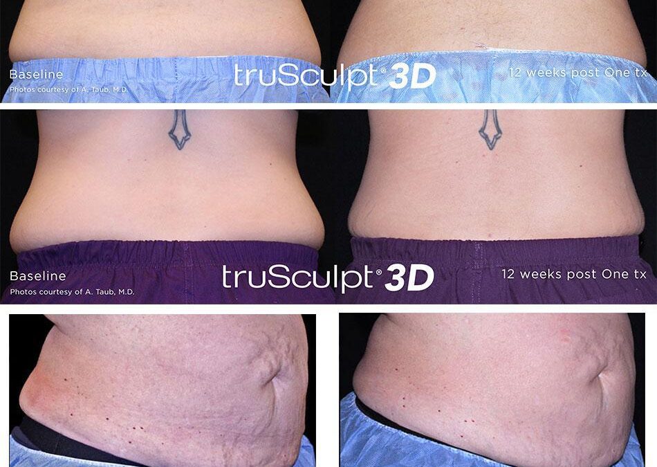 TruSculpt